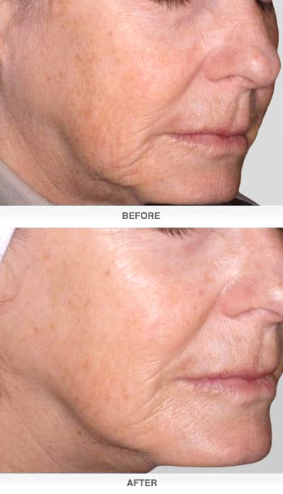 Exilis Treatment Before and After - DermaCare in Richland, WA