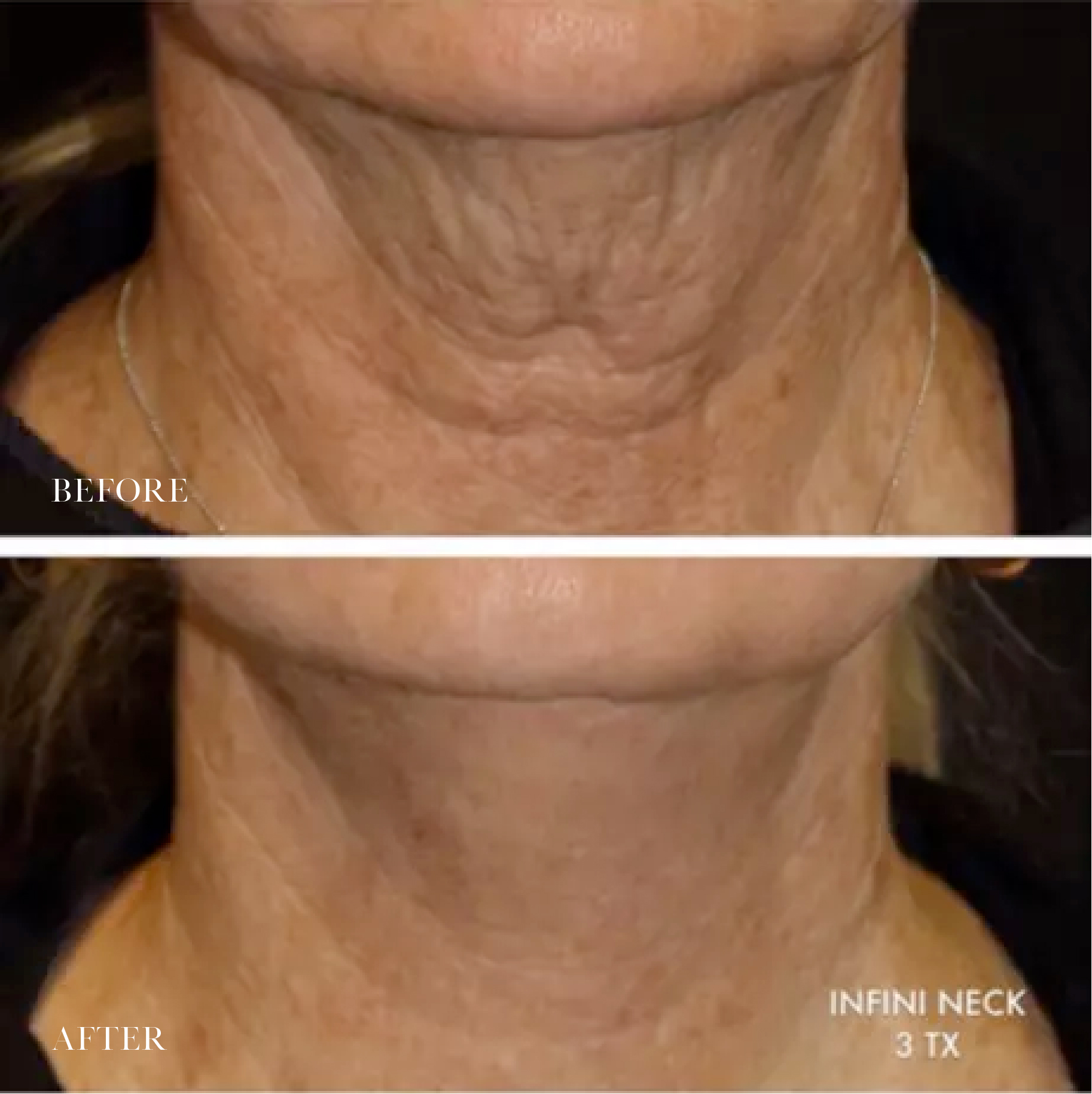 Kybella Injectable Service by DermaCare, Tri-Cities, WA Under Chin Fat Loss Before and After