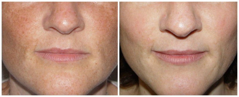 Kybella Injectable Service by DermaCare, Tri-Cities, WA Under Chin Fat Loss Before and After